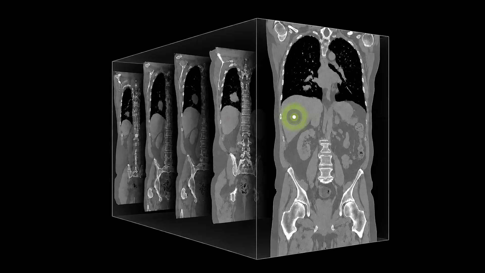 NVIDIA apresenta NV-Reason-CT, modelo aberto para analisar exames 3D de tomografia
